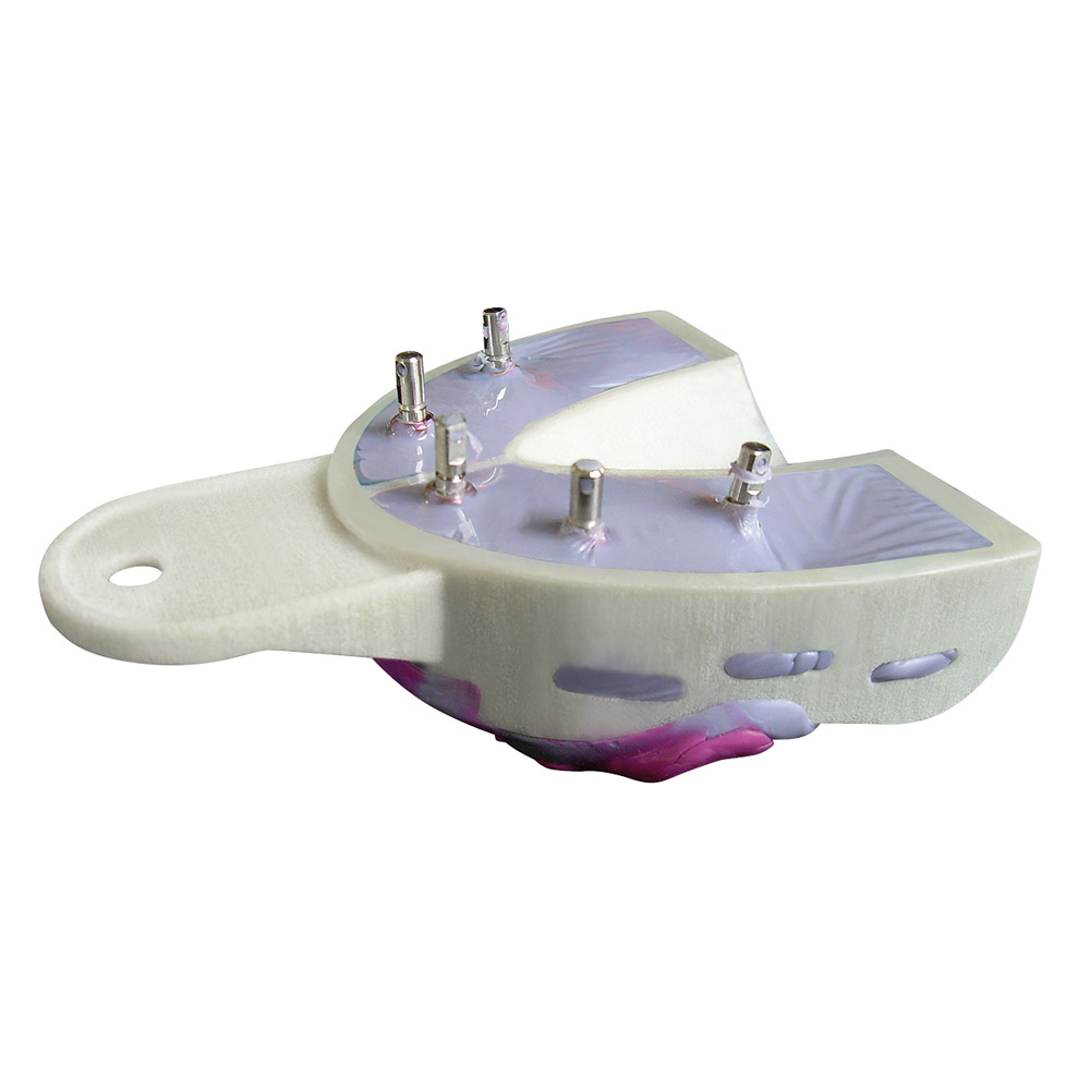 Miratray Implant afdruklepel UK I3, 6 stuks Set